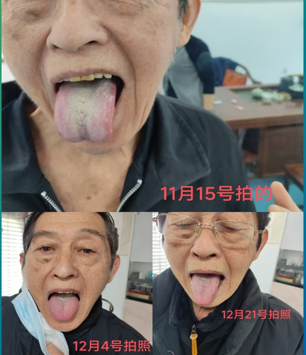 吃bifido益生菌舌苔明显好转